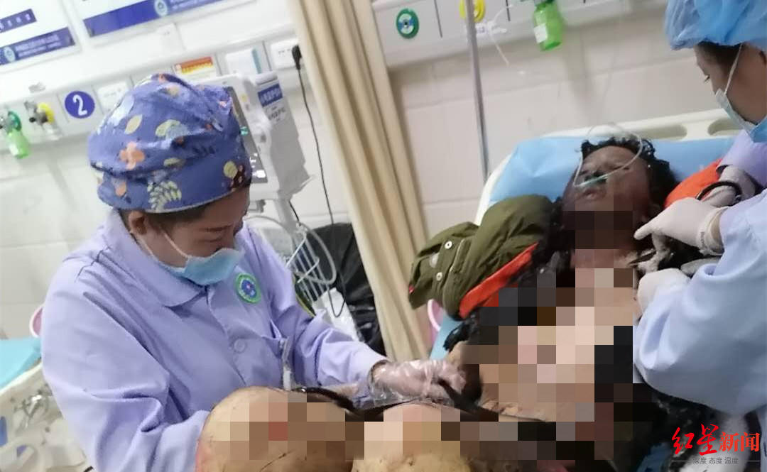 网红拉姆遭前夫纵火焚烧重度烧伤，已转院成都 表姐：她病情危重仍重度昏迷-2.jpg