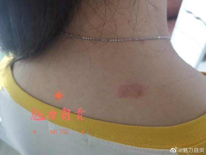 【#自贡#有人高空抛烟头！还燃着的，把行人脖子都烫红了[怒]】-1.jpg