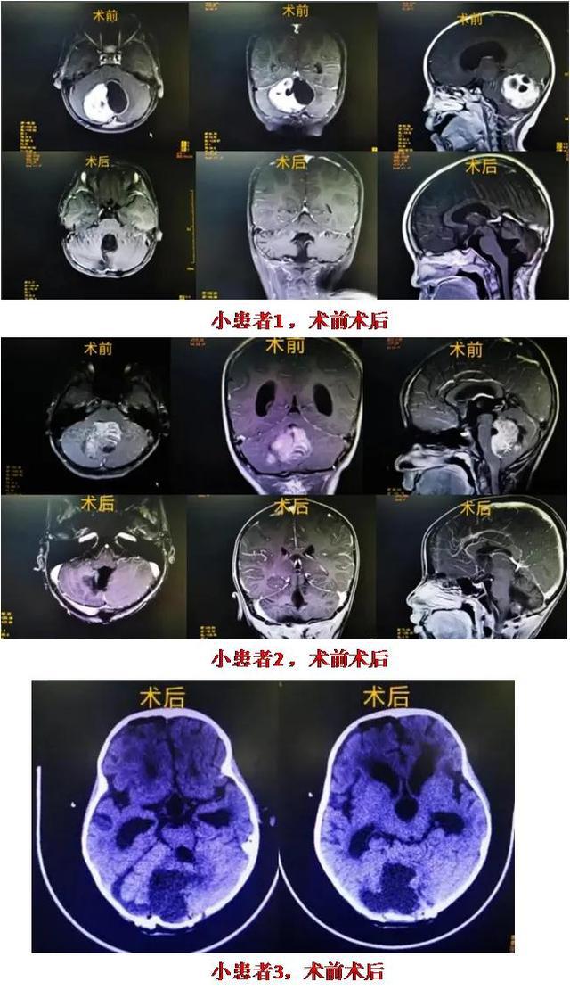 自贡市第一人民医院成功救治3名高危脑肿瘤儿童-1.jpg