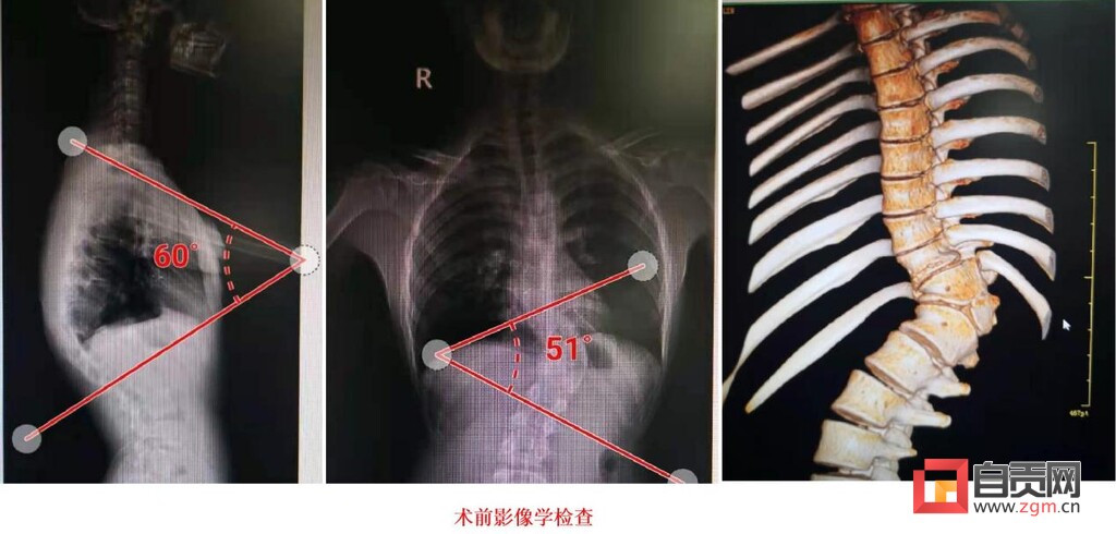 脊柱唤醒后“长高”9厘米 少年打开折叠年华-2.jpg