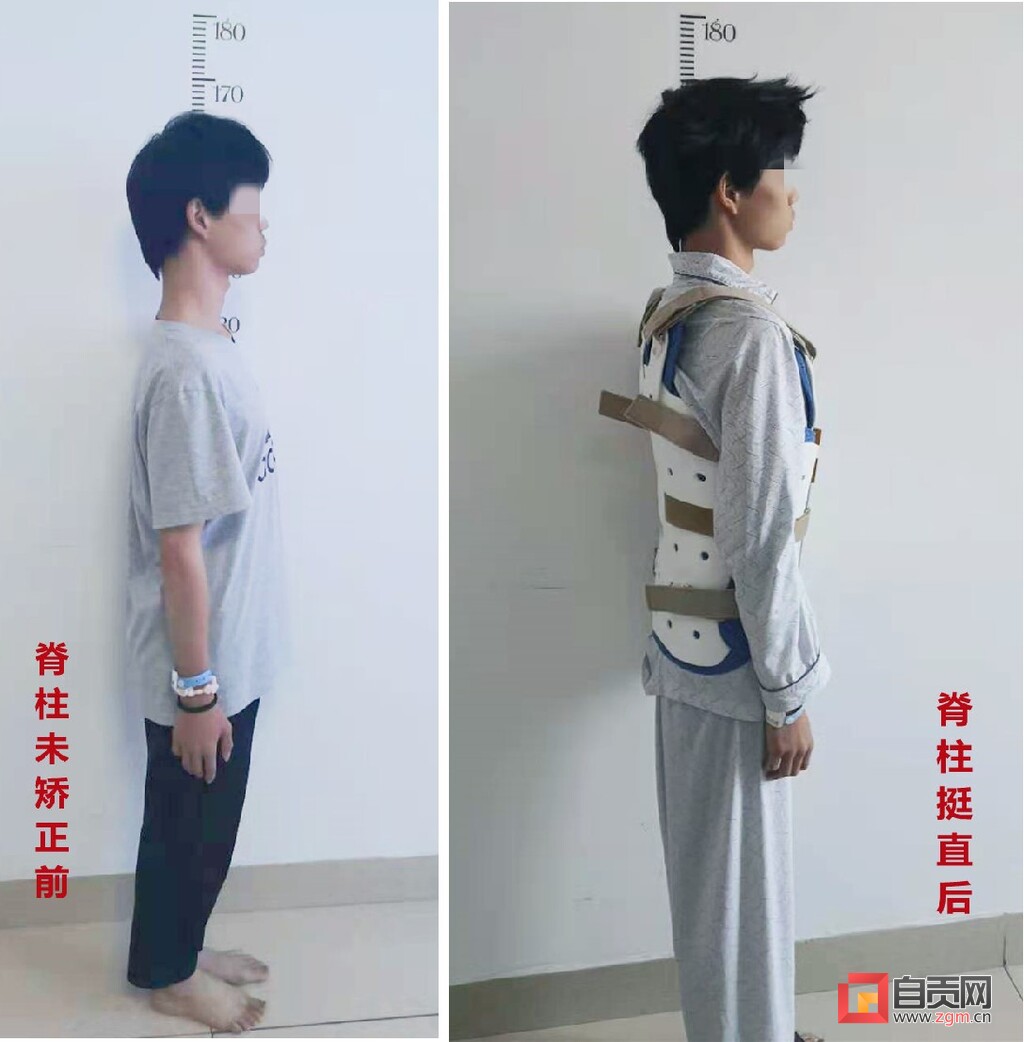 脊柱唤醒后“长高”9厘米 少年打开折叠年华-3.jpg