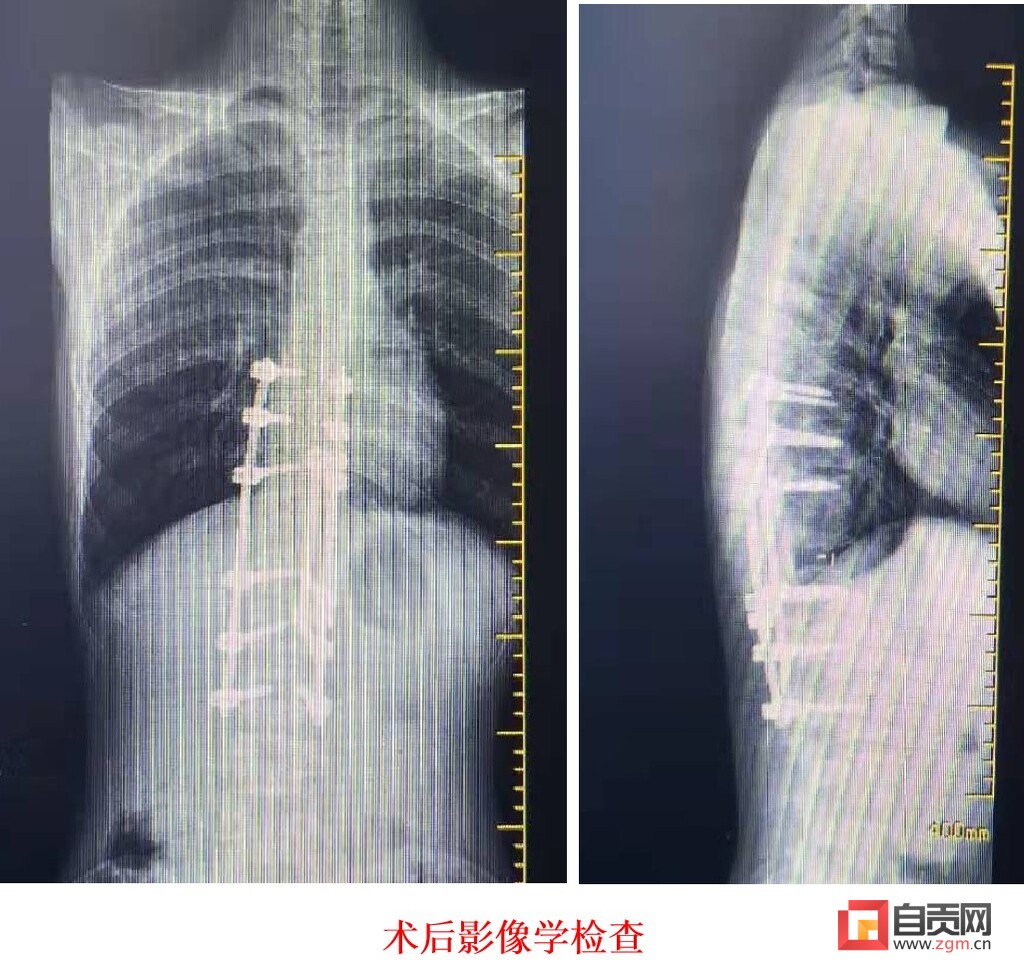 脊柱唤醒后“长高”9厘米 少年打开折叠年华-4.jpg