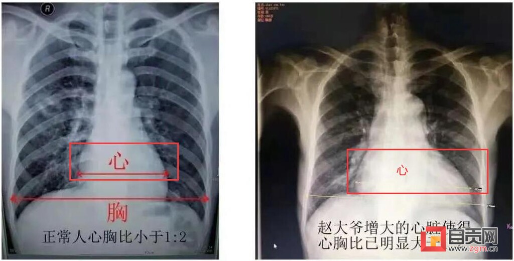 保护血透生命线 快快拯救“大心脏”-1.jpg