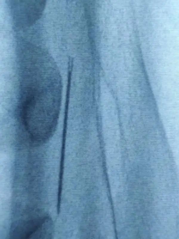 男子洗澡发现背部有一条“缝衣线”！医生：再晚一点送来就危险了-1.jpg