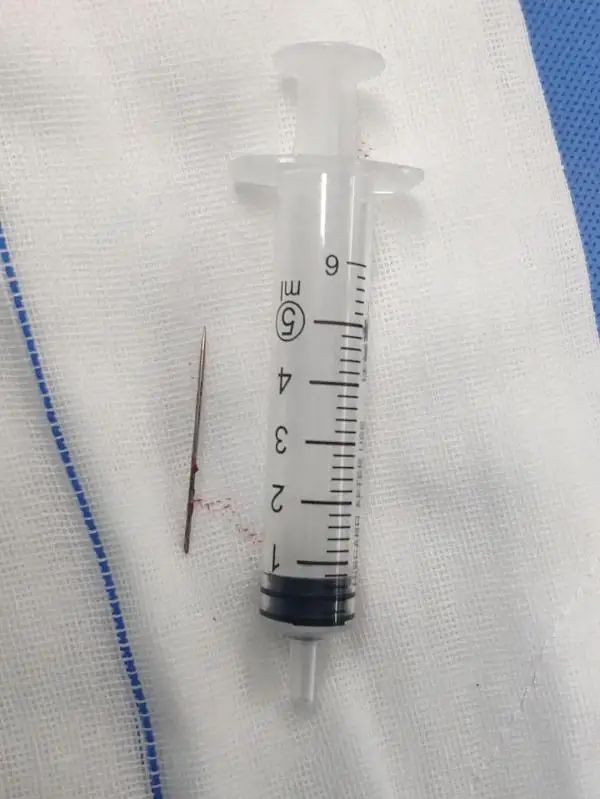 男子洗澡发现背部有一条“缝衣线”！医生：再晚一点送来就危险了-2.jpg