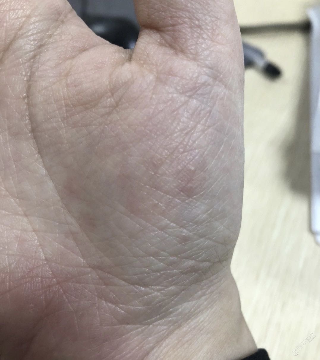 手痒来就知道夏天来了，什么都没有这个准，有没有办法根治-1.jpg