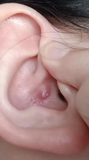 最近耳朵里面的壁上面长了点硬硬的痘痘，请问是上火吗？-1.jpg