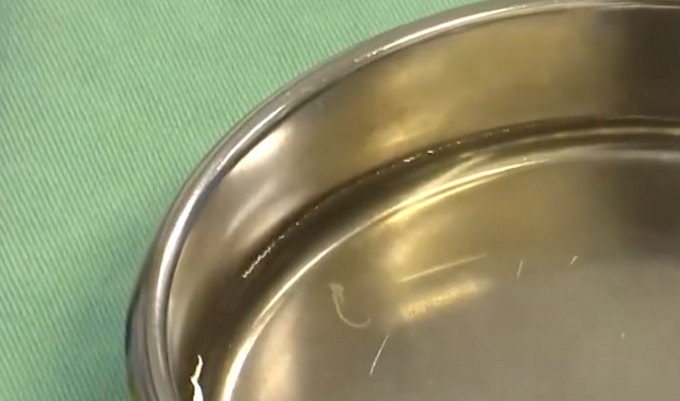 2岁男童眼睛现4条寄生虫游动：患儿曾有过犬类密切接触史-1.png