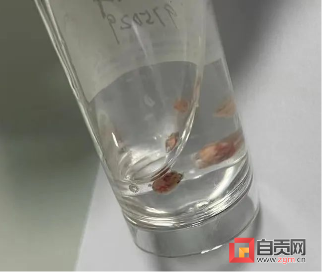 精准诊断！自贡市第一人民医院成功开展软硬支气管镜联合下冷冻肺活检术-2.png