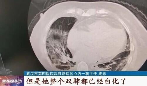 老人去世比往年多很多？专家释疑 关于白肺需要注意这些问题-1.jpg