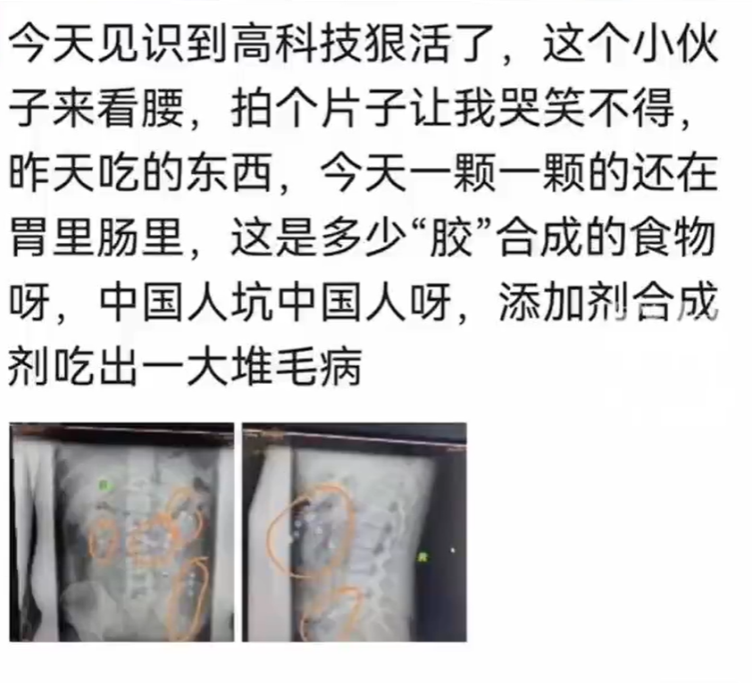19岁小伙因腰痛去医院拍片，肠胃里竟全是奶茶“珍珠”，医生：见识到高科技狠活了-3.jpg