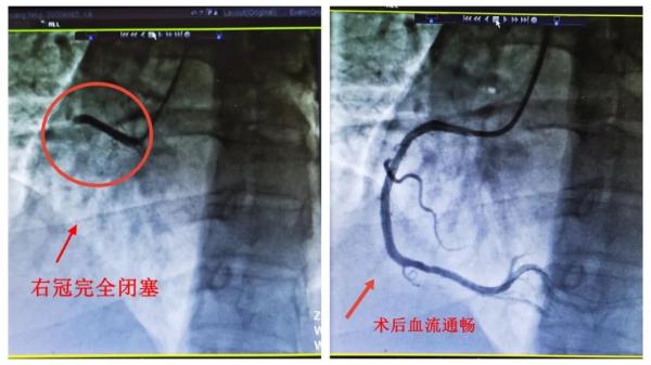 阳性一个月后，风险增加33倍！这些同时就医的肺梗心梗患者，竟都和出汗脱水有关-4.jpg