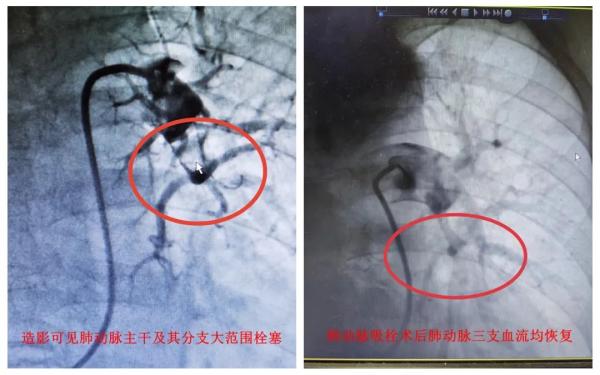 阳性一个月后，风险增加33倍！这些同时就医的肺梗心梗患者，竟都和出汗脱水有关-2.jpg