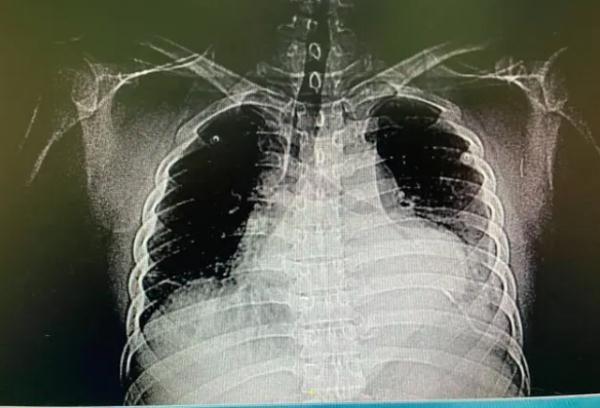 36岁男子头疼自己在家针灸扎破心脏进了ICU，网友：真“扎心”-2.jpg