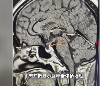 男子每天喝30斤水去50次厕所 喝水要用盆来接-1.jpg