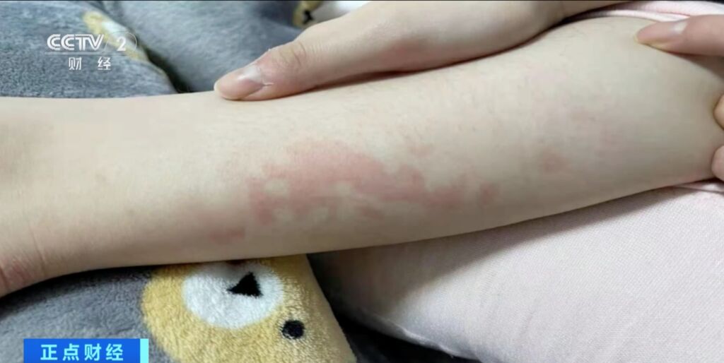 冬季警惕发生低温烫伤！医生提醒：不要通宵使用电热毯-4.jpg