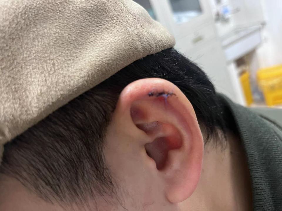 小伙理发时耳朵被剪缝六针：双方未就赔偿达成一致，涉事理发师仍上班-1.jpg