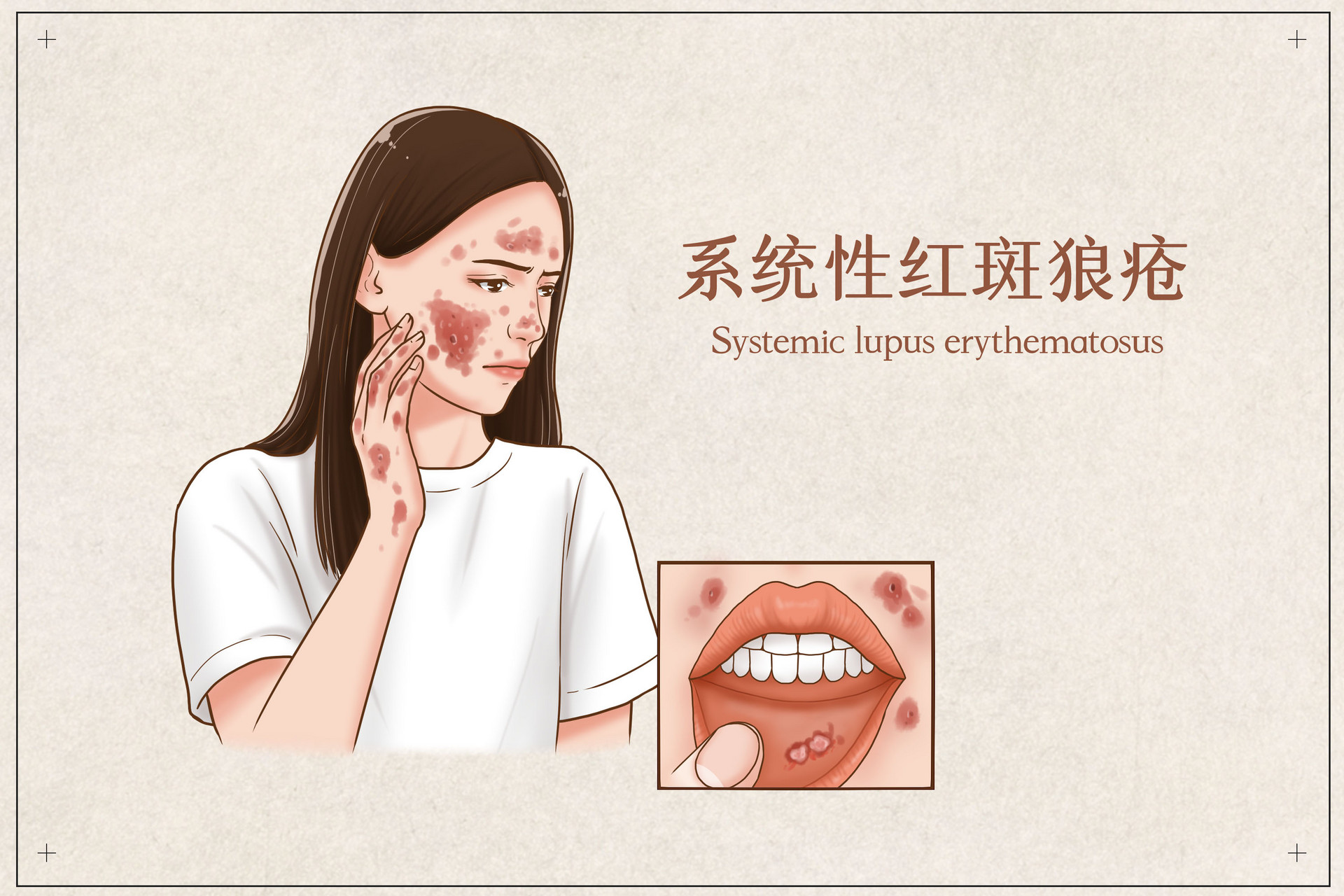 红斑狼疮有什么症状，能治好吗？-1.jpg
