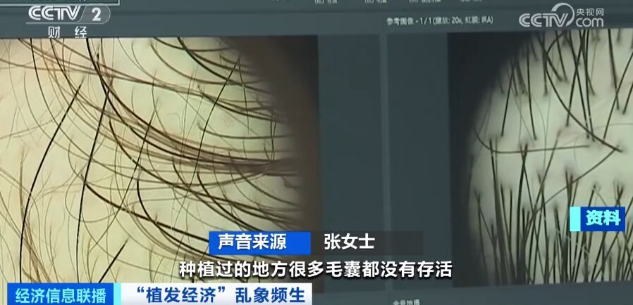 曝光了！“没长出来”“秃的”！有人欠下万元“植发贷”……-1.jpg