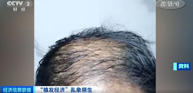 曝光了！“没长出来”“秃的”！有人欠下万元“植发贷”……-2.jpg