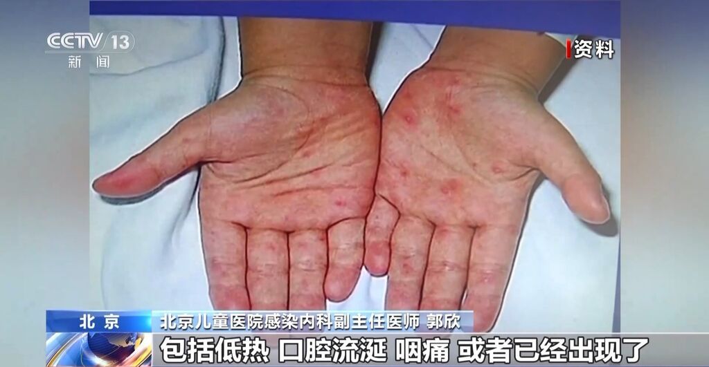 家长请注意！又到手足口病高发期小心孩子的这些症状-1.jpg