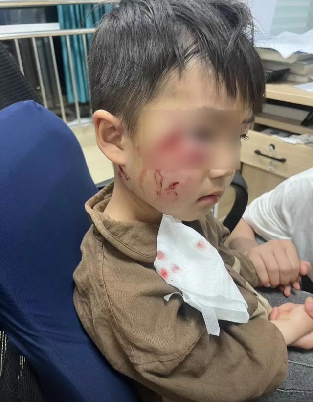 3岁男童被狗咬伤18天后离世，狗仍去向不明？当地回应橙柿：警方已提级调查-2.jpg