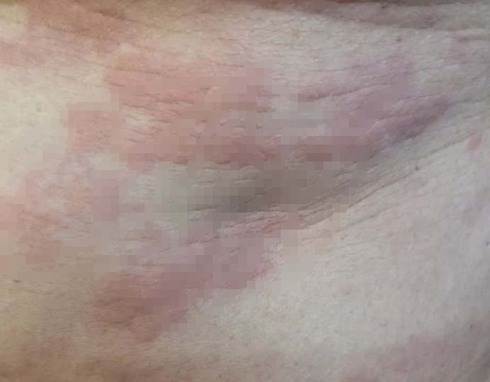 身上密密麻麻！杭州女子疯狂洗晒后，突然发现不对劲！很多人中招-2.png