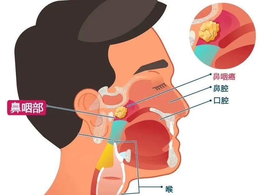 15岁男孩患癌，只因忽视这一“小毛病”……-3.jpg