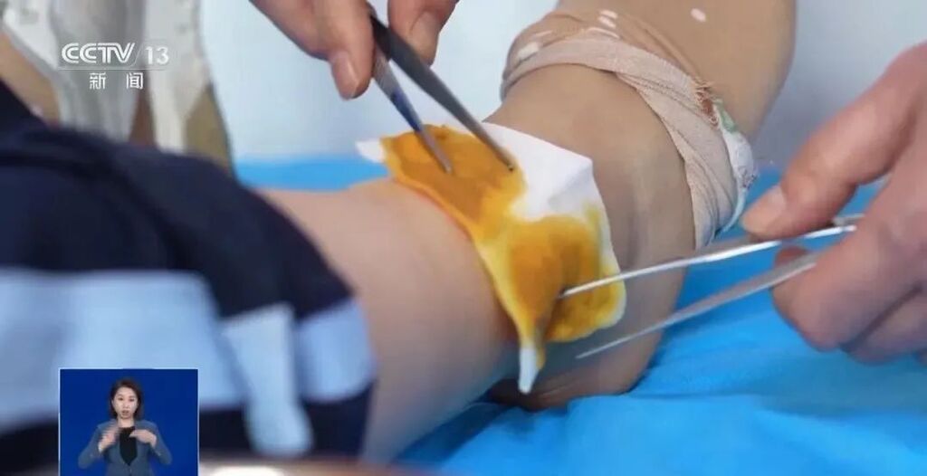 热水袋竟致三级烫伤！谁说温度低就不会烫伤了？-3.jpeg