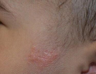 头上的痣暗藏癌变风险？出现这3种情况一定要警惕-2.jpg