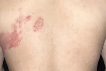 “最疼皮肤病”进入高发期 出现这些疼痛信号别大意-2.jpg “最疼皮肤病”进入高发期 出现这些疼痛信号别大意-2.jpg