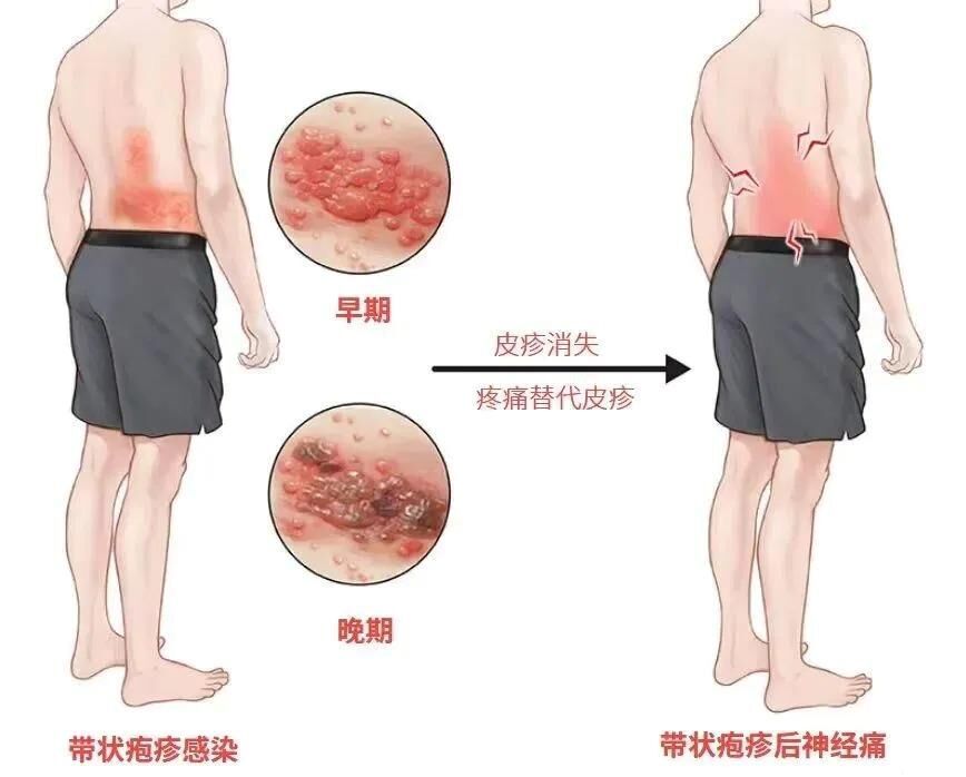 “最疼皮肤病”进入高发期 出现这些疼痛信号别大意-1.jpg “最疼皮肤病”进入高发期 出现这些疼痛信号别大意-1.jpg