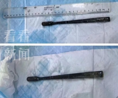 男子胃痛多年就医，坦言27年前吞过一把牙刷，医生一查：胃里还有另一把！-2.png