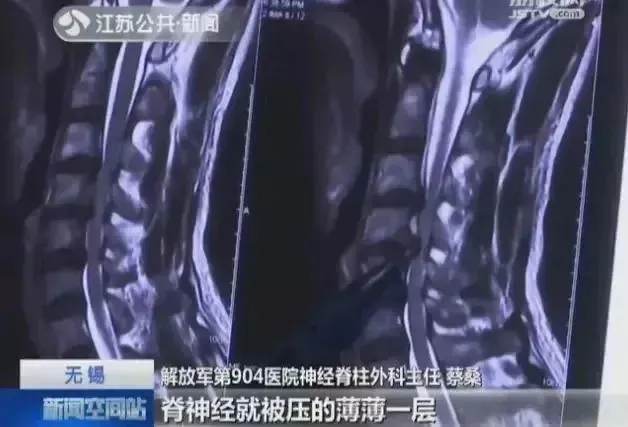 女子夜里翻身拿手机突然瘫痪！19 岁小伙长时间低头高位瘫痪！-3.webp